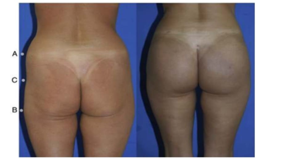 Hình. 9. Minh họa khung vuông, cao trước (trái) và sau (phải) phẫu thuật chỉnh hình mông.