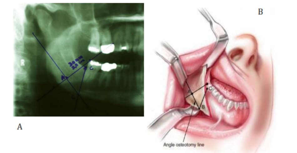 Hình 38-10 Một đường thẳng nối từ điểm B đến A và kéo dài tiếp đến phần sau xương hàm dưới chính là đường cắt phần góc xương hàm dưới.