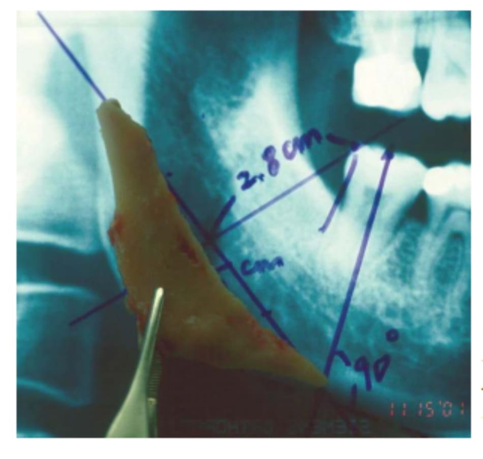 Hình 38-11 Phần tách bỏ của phần góc xương hàm dưới đối chiếu trên hình ảnh Xquang.