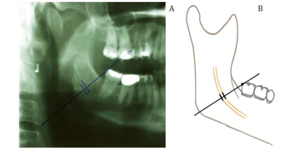 Hình 38-2 Đường nối từ góc sau răng cối trên cùng đến điểm xa nhất thuộc góc xương hàm dưới (đường góc – răng)