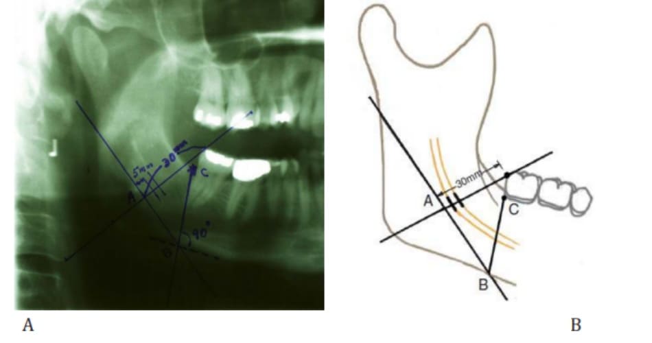 Hình 38-6 Khoảng cách giữa răng cối và điểm A được đo. Trên hình ảnh xương hàm dưới này, khoảng cách đó là 30 mm.