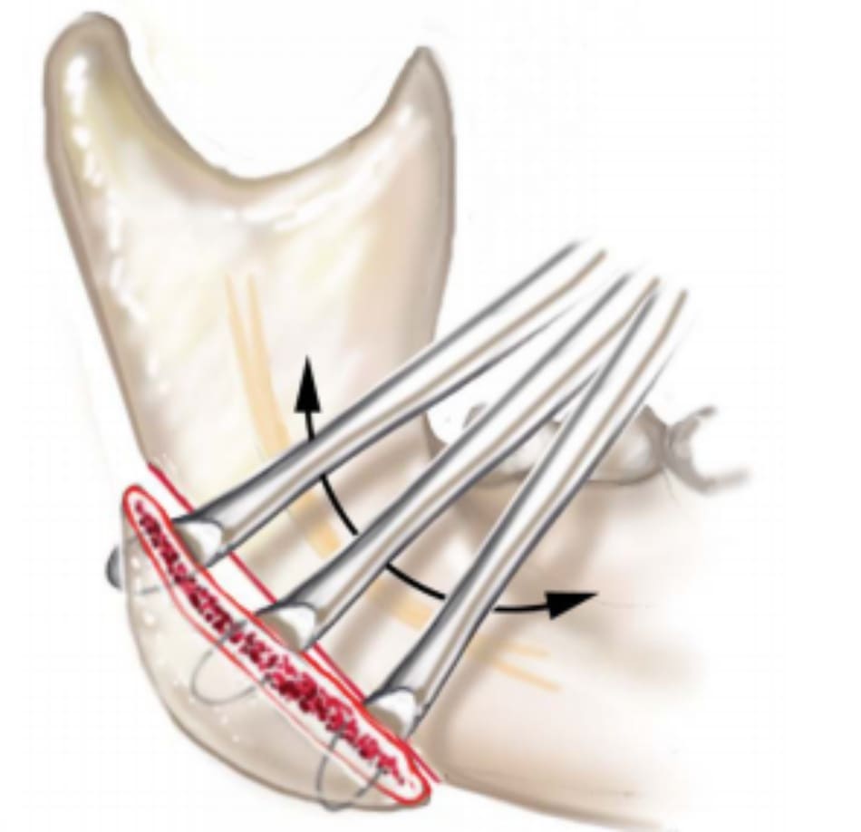 Hình 39-11 Màng xương ở cạnh giữa phần góc xương hàm được nâng lên.