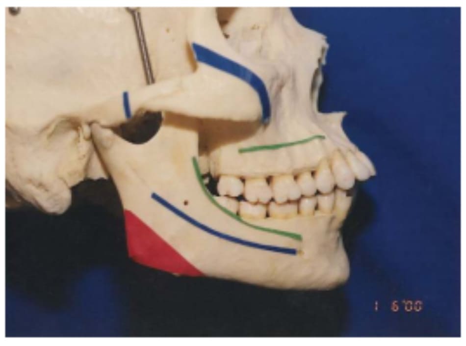 Hình 39-3 Đường xanh lá cây trên xương hàm dưới chỉ vết rạch vùng niêm mạc – nướu, đường xanh dương chỉ đường đi của đường hầm cho bó mạch thần kinh huyệt răng dưới, và đường đỏ biểu thị tam giác góc hàm cần cắt bỏ.