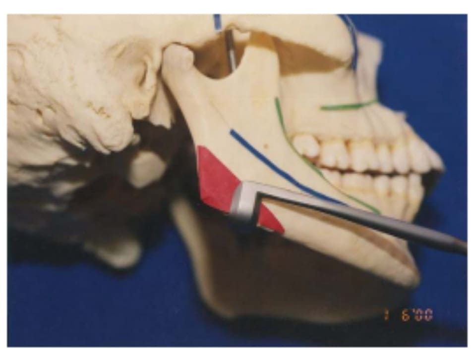 Hình 39-4 Màng xương được lột từ bờ dưới bằng dụng cụ lột Obwegeser