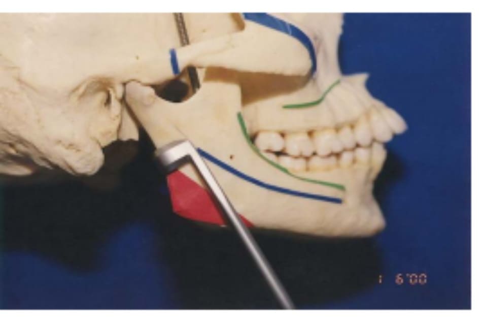 Hình 39-5 Cận cảnh bờ sau ngành xương hàm
