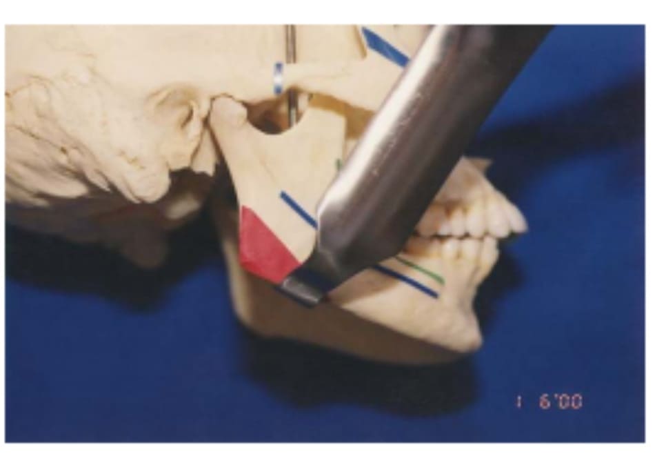 Hình 39-7 “Retractor” theo đường dọc phần xương cắt Obwegeser đặt ở bờ dưới xương hàm. 