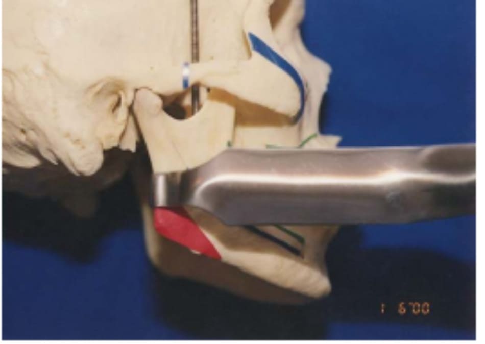 Hình 39-8 “Retractor” theo đường dọc phần xương cắt Obwegeser đặt ở bờ sau ngành xương hàm