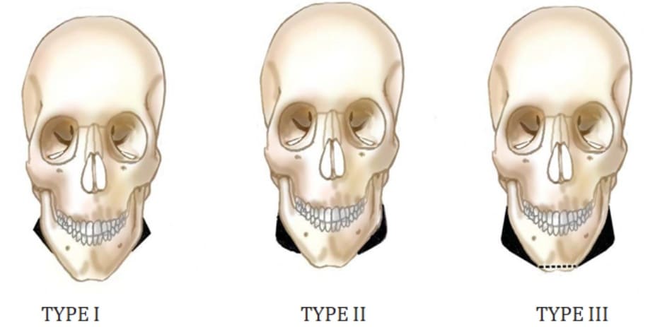 Hình 40-1 Classification of the shape of the mandible. Type I: The mandibular angle juts out conspicuously. Type II: The mandibular angle is curved posteromedially and the mandibular body protrudes in convexity. Type III: Type II, with loss of the vertical height of the chin.