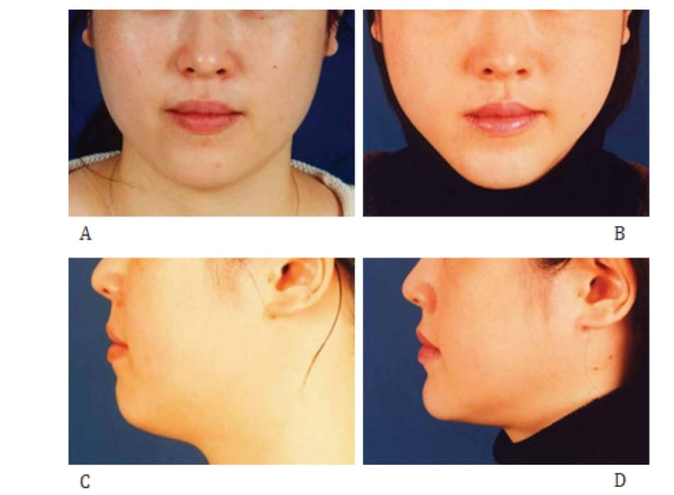 Hình 40-3 Case 2: Phẫu thuật cắt – tách góc hàm và đẩy trượt phần dưới xương hàm dưới ở một phụ nữ 24 tuổi. Trước phẫu thuật (A,B) và 3 tháng sau phẫu thuật (C,D).