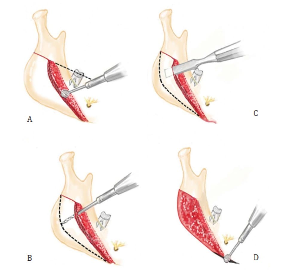 Hình 40-5 Minh họa cắt – tách góc xương hàm. A, vùng hình chấm đỏ được cạo bằng mũi khoan tròn, và lưỡi khoan xuyên tạo một rãnh sâu đi dọc theo đường từ mặt cắn. Rãh này là ranh giới trên của phần xương được tách đi. B, một lưỡi khoan dùng để tạo đường hầm ở các khoảng 2 – 3 mm. Phần vỏ ở bên và giữa được cắt bỏ trong trường hợp bờ sau dưới nhô ra ngoài. C, vỏ được tách bằng dụng cụ đục rộng 10 mm dọc theo đường hầm. D, phần xương sau cắt ở bờ dưới xương hàm gần lỗ cằm được tỉa gọn bằng khoan lưỡi tròn.