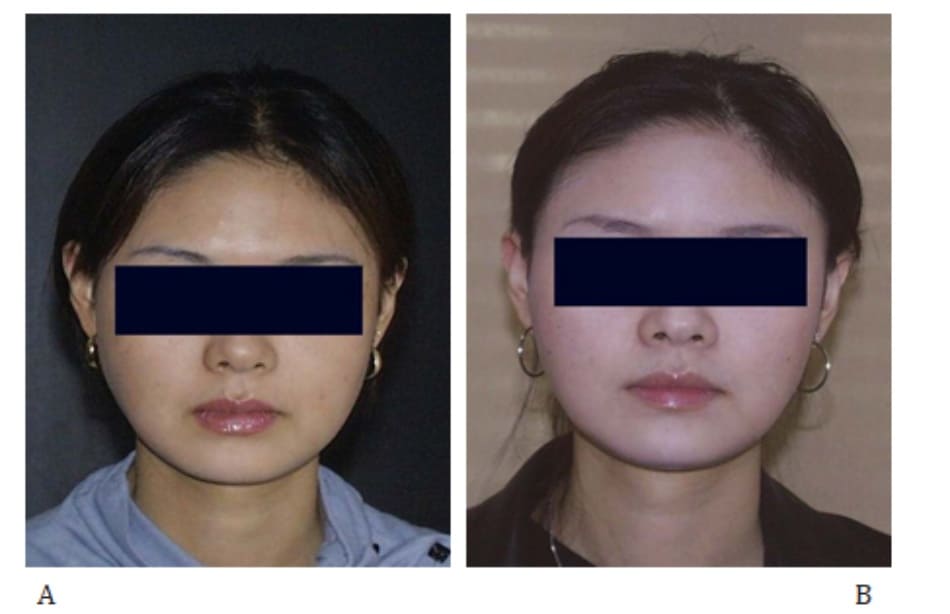 Hình 41-6 A, hình ảnh 3 tháng sau thủ thuật. B, Hình 4 tháng sau tiêm mũi thứ hai, tức 12 tháng sau mũi tiêm đầu tiên.