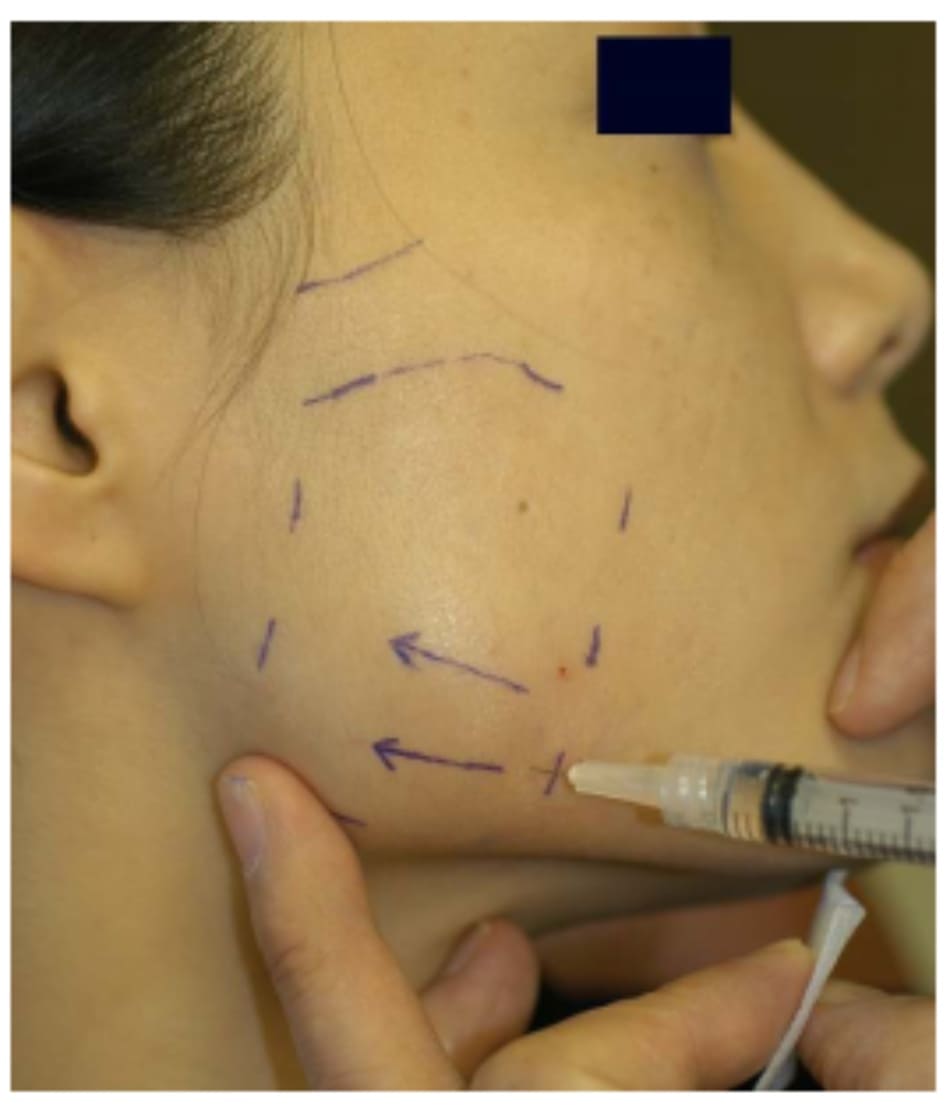 Hình 41-8 Ngón trỏ bên trái giữ góc hàm để định hướng. Bệnh nhân tiếp tục co cơ bằng cách cắn chặt hàm. Tiếp cận theo chiều ngang từ trước được ưa chuộng. 