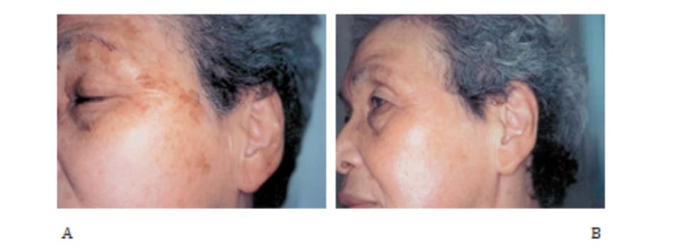 Hình 42-4 A, Trước peel. Bệnh nhân nữ 72 tuổi bị lão hóa da do ánh sáng. B, Sau peel.