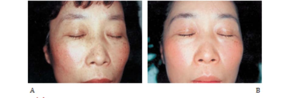 Hình 42-5 A, Trước peel. Bệnh nhân nữ 47 tuổi bị lão hóa da do ánh sáng và tăng sắc tố rải rác. B, Sau peel.