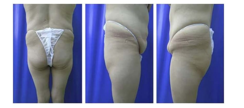  Hình. 2. Bệnh nhân với khung chậu quá rộng hoặc quá ngắn đều không phù hợp với implant mông.