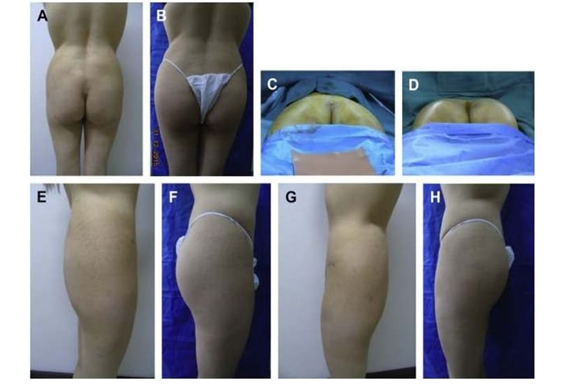 Hình. 3. (A-H) Tiền phẫu, chu phẫu và sau hậu phẫu 6 tháng của một bệnh nhân nữ 38 tuổi được ghép túi độn mông với thể tích 330 cm3.