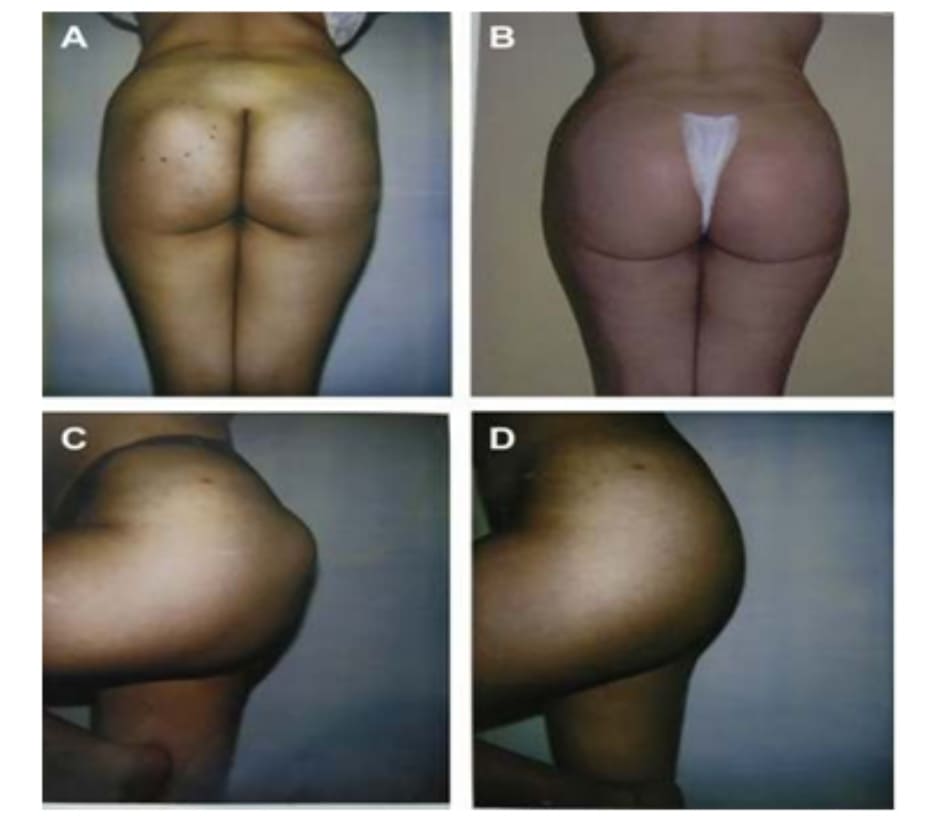 Hình. 7. (A-D) Hình ảnh tiền phẫu và hậu phẫu của bệnh nhân thoát vị khối implant ở mông trái.