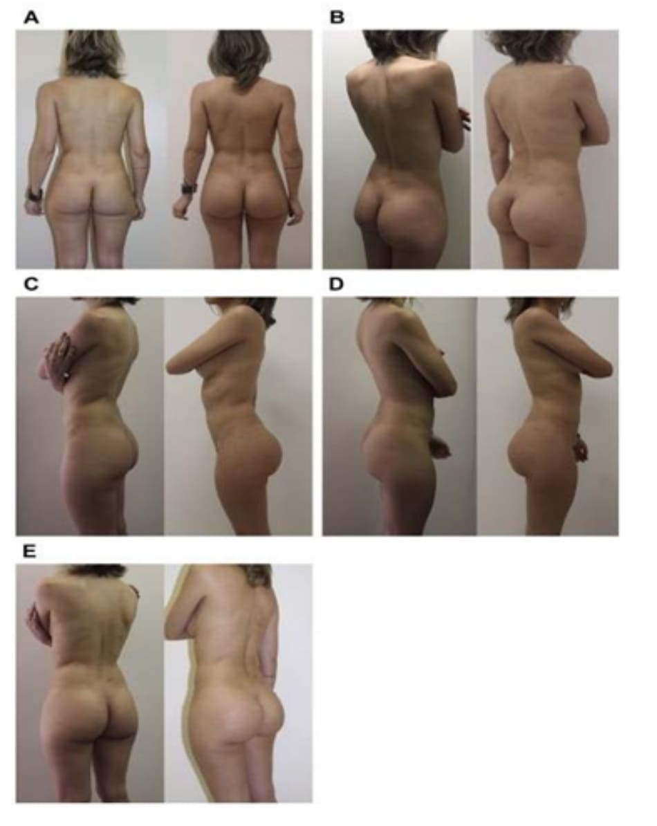 Hình. 10. Ca 3: Hình ảnh tiền phẫu (bên trái) từ phía sau, chếch sau phải của 1 bệnh nhân 29 tuổi với tình trạng thiểu sản vú và mông (A, C và E). Hình hậu phẫu (bên phải) sau 1 năm nhìn từ phía trước, chếch phải và bên phải sau khi implant ngực 2 bên thể tích 180 mL/bên và mông hai bên thể tích 235mL/bên kết hợp với ghép mỡ tự thân (B,D).