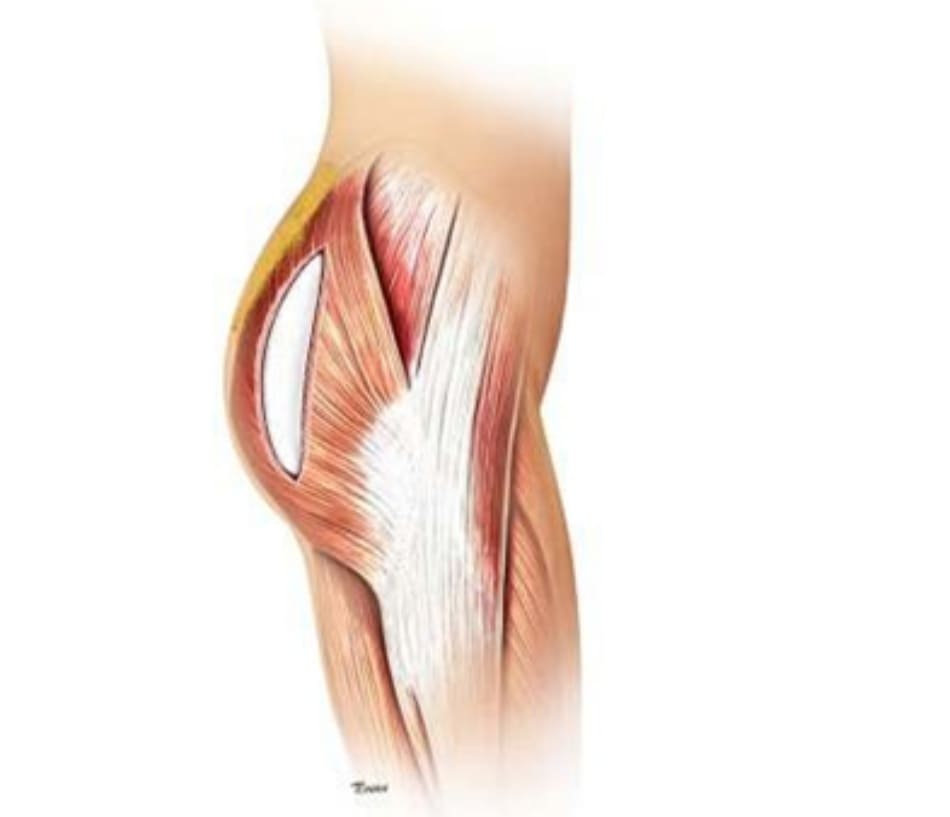 Hình. 7. Tiêm mỡ vào phần mông trên giúp tạo sự liên tục từ vùng thắt lưng cùng tới mông, đường nét cơ thể sẽ tự nhiên hơn.