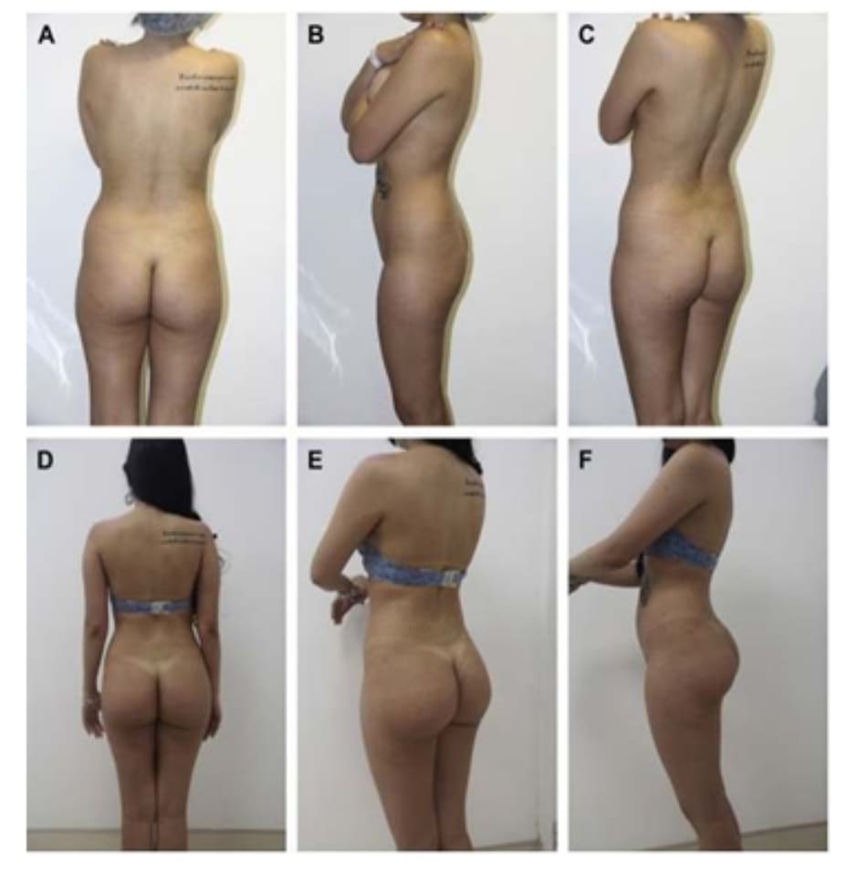 Hình. 9. (A-F) Ca 2: hình ảnh trước phẫu thuật nhìn từ phía sau, chếch sau phải, và bên phải bệnh nhân nữ 23 tuổi với tình trạng thiểu sản mông (Hình. 3A, C, và E). Hậu phẫu (1 năm) nhìn từ phía sau, chếch sau phải và bên phải của bệnh nhân với khối implant thể tích 375 mL, và ghép mỡ tự thân (B, D, và F).