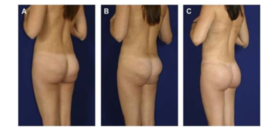 Hình. 7. (A) Bệnh nhân nữ 36 tuổi phàn nàn về tình trạng lộ mô cấy dưới da ở cưc trên của mông. Trên hình CT, các mô cấy nằm bên trong cơ lớp cơ mỏng và phần cơ còn lại bị dồn xuống dưới, tạo ra hiệu ứng bong bóng kép. (B) Khi co cơ, có thể thấy rõ khối implant lộ dưới da. Chỉ có phần dưới của cơ co lại do khối implant đã chiếm chỗ hết ở cực trên. (C) Các mô cấy cũ được lấy ra, mặt phẳng được đóng kín bởi chỉ Vicryl 2-0 và tạo lại mặt phẳng mới, đặt túi mới. một dẫn lưu được đặt cạnh túi implant mới để tránh biến chứng bướu huyết thanh. Đây là một biến chứng thường gặp khi loại bỏ và thay thế các mô cấy. Sau 4 tháng, các mô cấy được thay thế bằng phương pháp XYZ. Hình (C) là kết quả thu được sau 6 tháng cấy ghép lại.