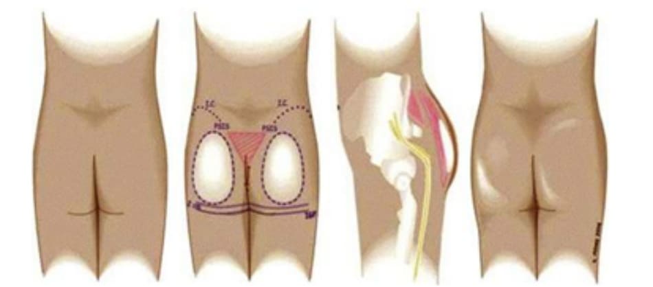 Hình. 1. Tương quan giải phẫu và vị trí của khối implant dưới cân cho thấy, chúng phải nằm ở vị trí trung tâm của mông và được che phủ hoàn toàn bởi hệ thống cân mạc bao phủ cơ. Dây thần kinh hông to, có thể nhìn thấy rõ từ phía bên, cách túi implant một khoảng cách tương đối an toàn. (Trích từ de la Peda JA. Subfascial technique for Gluteal Augmentation. Aesthet Surg J 2004;24:265-73; đã xin phép trước khi đăng tải.)
