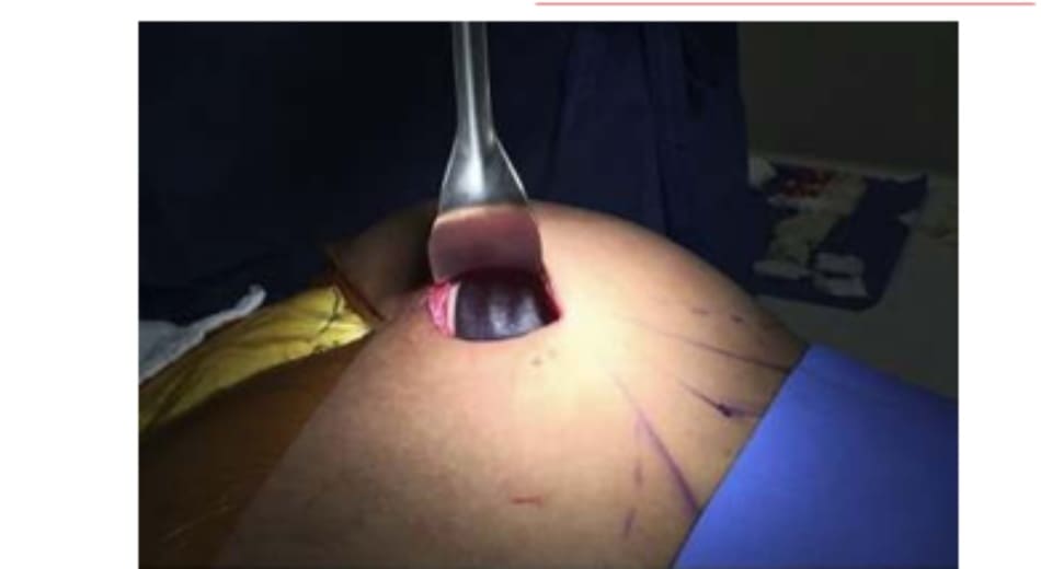 Hình. 15. Đường chia đôi mông theo phương ngang phải đi qua đường trắng giữa của khối implant để đảm bảo khối này được đặt đúng vị trí.