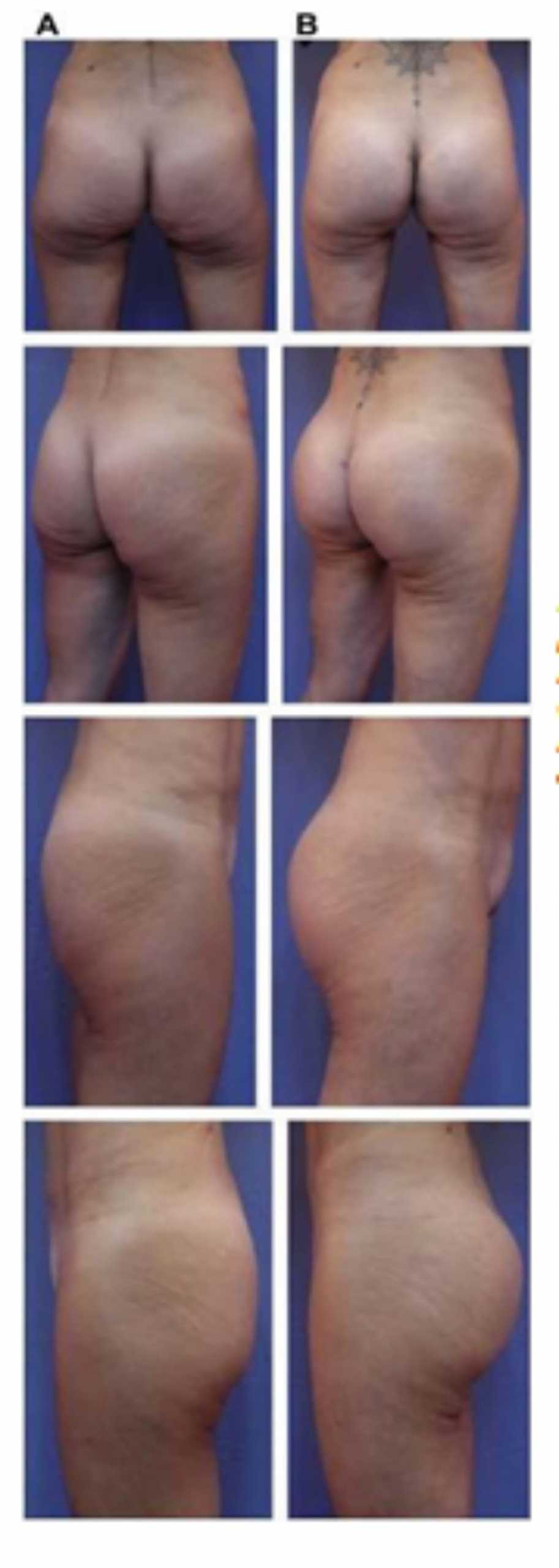 Hình. 19. . (A) Hình anh trước và (B) và sau phẫu thuật làm đầy mông của bệnh nhân chùng da vùng mông tương đối nhiều. Bệnh nhân được đặt khối implant dưới cân thể tích 330 mL ở hai bên.