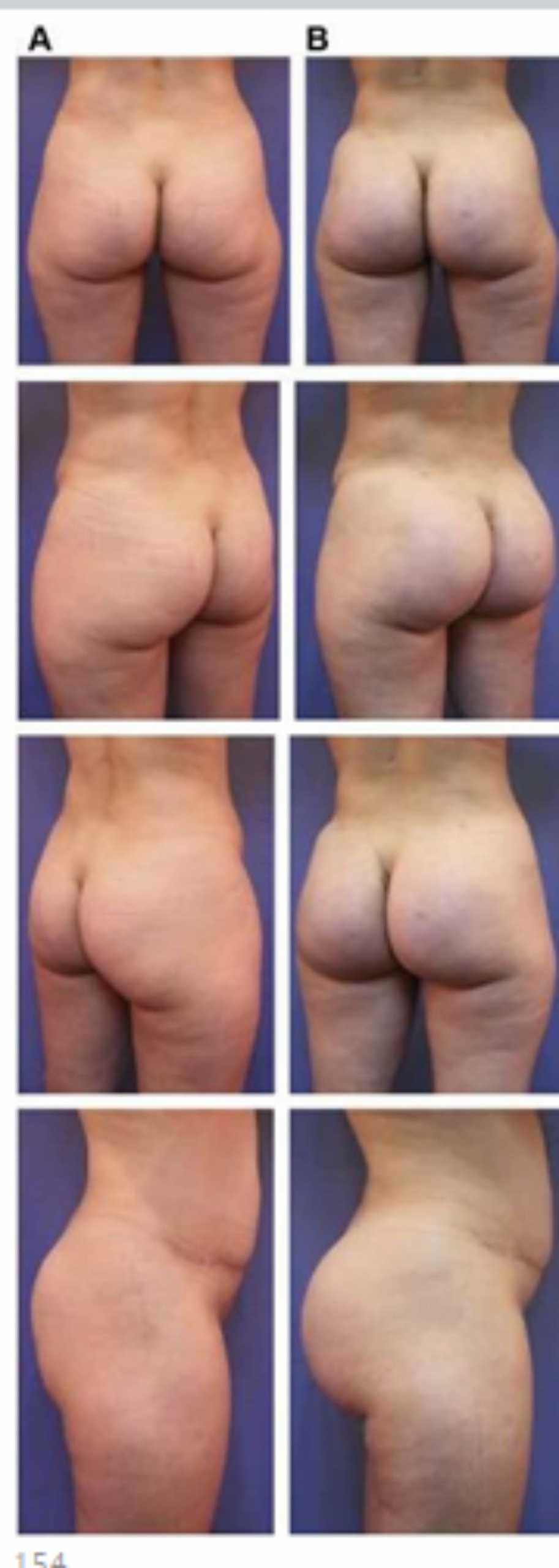 Hình. 20. (A) Hình anh trước và (B) và sau phẫu thuật làm đầy mông của bệnh nhân có vùng mông tương đối đầy đặn. Bệnh nhân được đặt khối implant dưới cân thể tích 330 mL ở hai bên.