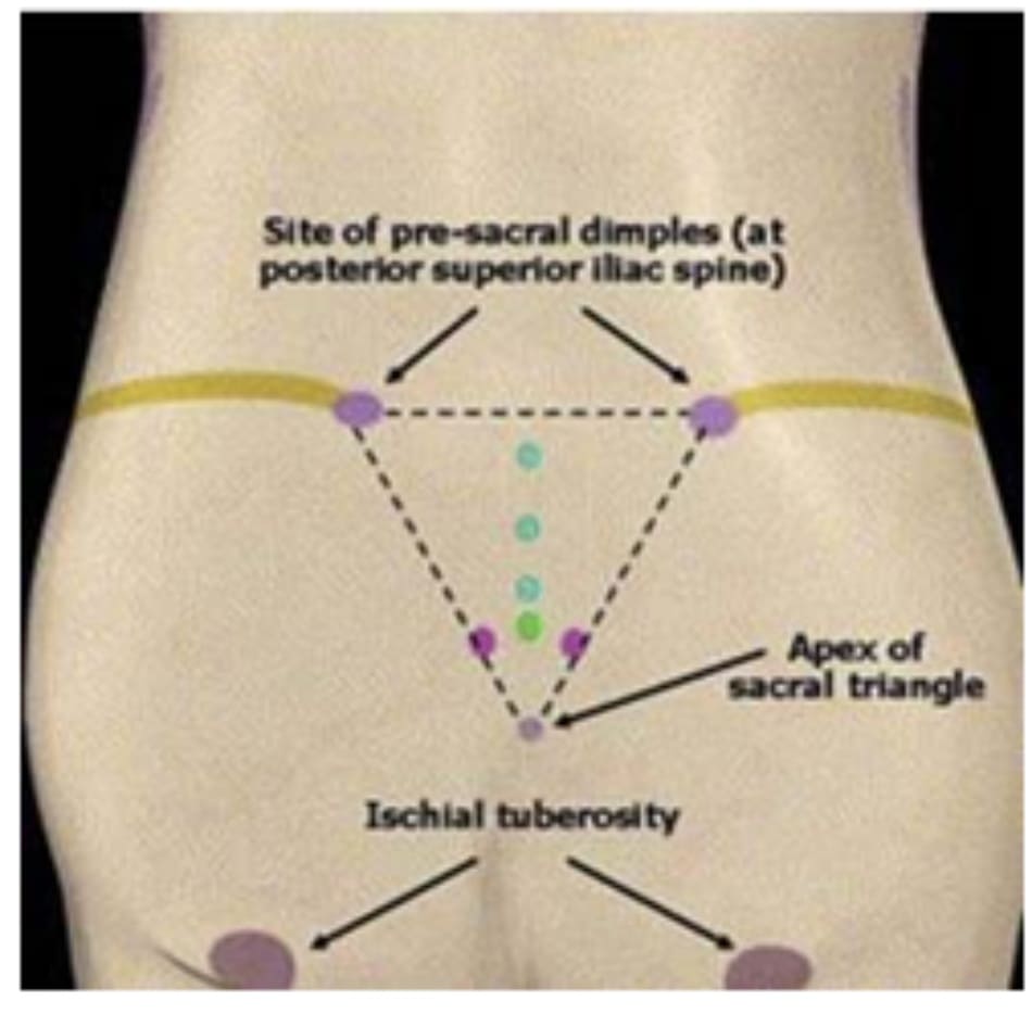 Hình 1. Các mốc giải phẫu quan trọng: mào chậu, gai chậu sau trên, xương cùng, xương cụt và ụ ngồi.