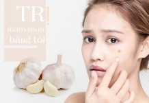Mách bạn 5 Công thức trị thâm mụn bằng tỏi đem lại hiệu quả bất ngờ Công thức trị thâm mụn bằng tỏi đem lại hiệu quả bất ngờ